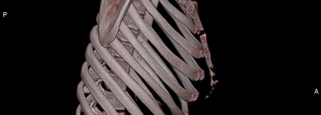 Brustwand_Fehlbildung