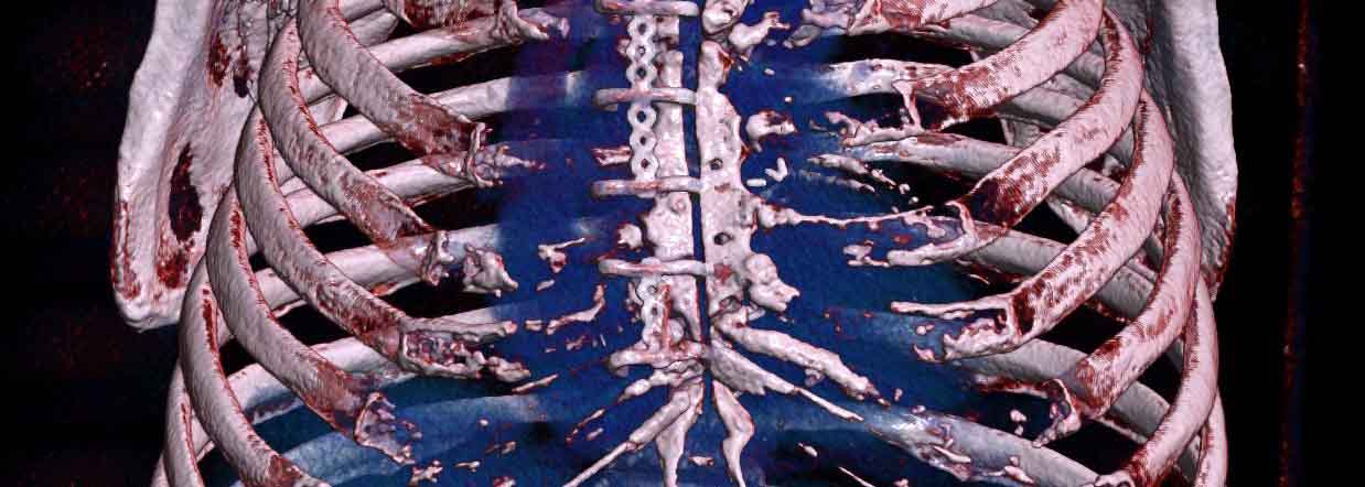 Brustwand-OP_3D rekonstruktion