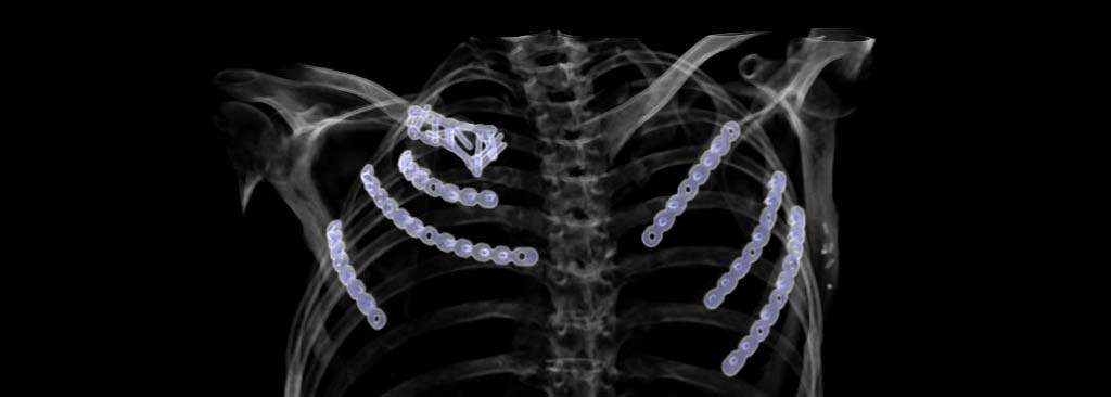 Brustwand_thoraxtrauma_3D