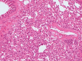 Entzündetes Lungengewebe mit vielen Immunzellen, deren Zellkerne blau angefärbt wurden. © HZI/Pils 