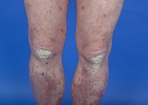 Psoriasis_Schuppenflechte